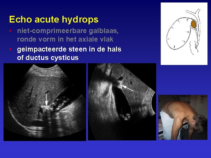 Echo acute hydrops • niet-comprimeerbare galblaas, ronde vorm in het axiale vlak • geimpacteerde