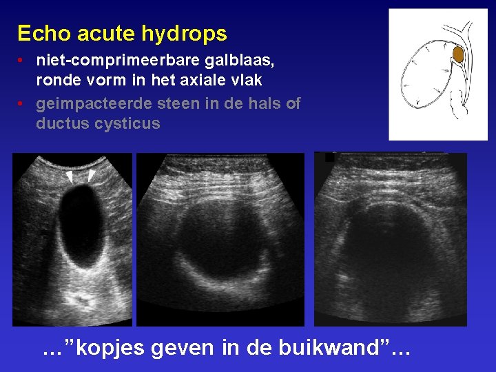 Echo acute hydrops • niet-comprimeerbare galblaas, ronde vorm in het axiale vlak • geimpacteerde