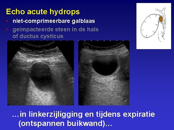 Echo acute hydrops • niet-comprimeerbare galblaas • geimpacteerde steen in de hals of ductus