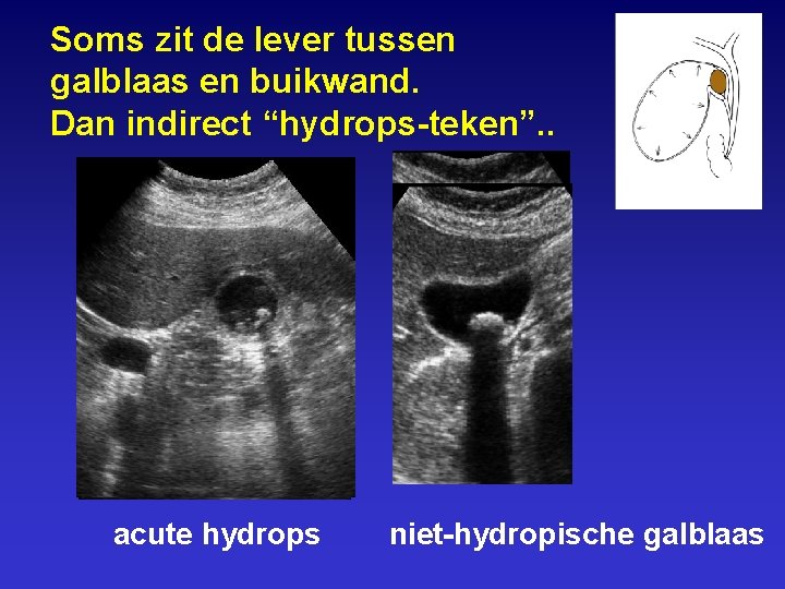 Soms zit de lever tussen galblaas en buikwand. Dan indirect “hydrops-teken”. . acute hydrops