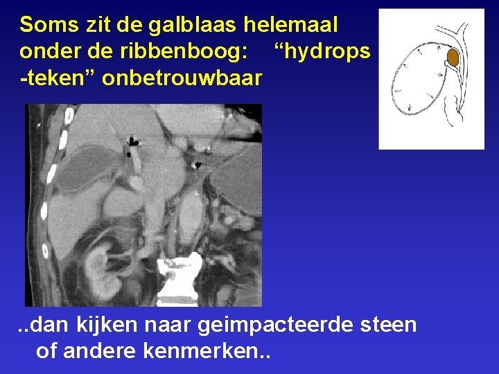 Soms zit de galblaas helemaal onder de ribbenboog: “hydrops -teken” onbetrouwbaar . . dan