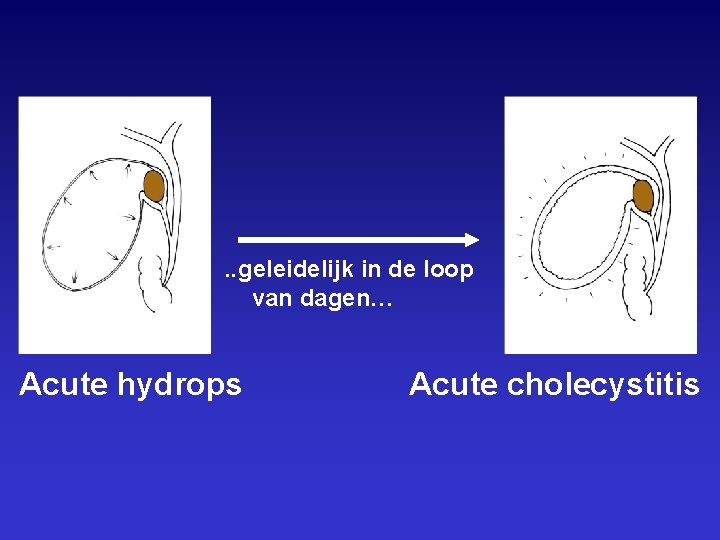 . . geleidelijk in de loop van dagen… Acute hydrops Acute cholecystitis 