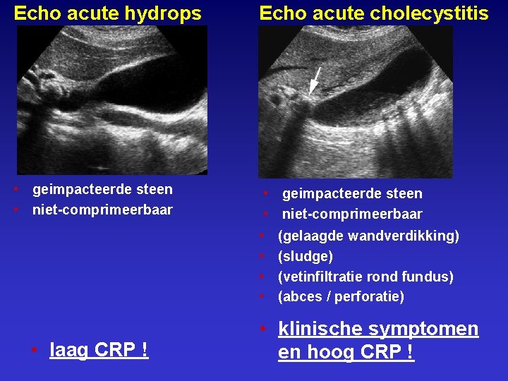 Echo acute hydrops Echo acute cholecystitis • geimpacteerde steen • niet-comprimeerbaar • • •