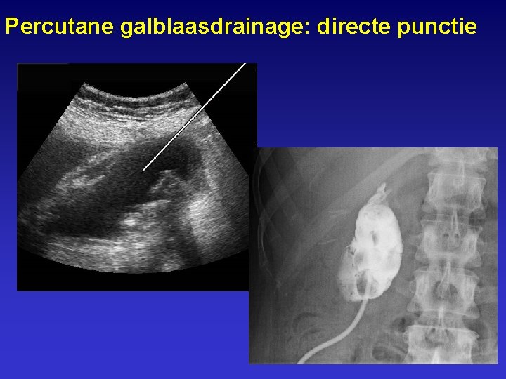 Percutane galblaasdrainage: directe punctie 