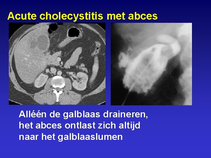 Acute cholecystitis met abces Alléén de galblaas draineren, het abces ontlast zich altijd naar