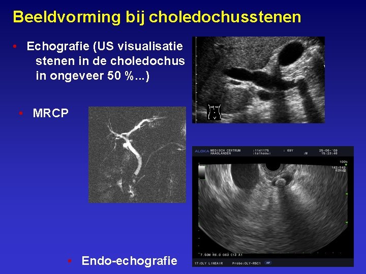 Beeldvorming bij choledochusstenen • Echografie (US visualisatie stenen in de choledochus in ongeveer 50