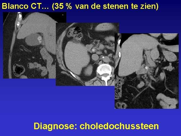 Blanco CT… (35 % van de stenen te zien) Diagnose: choledochussteen 