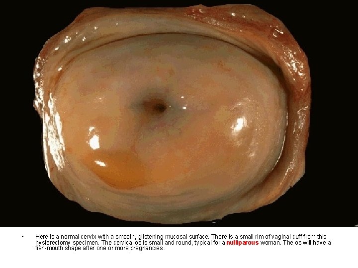  • Here is a normal cervix with a smooth, glistening mucosal surface. There