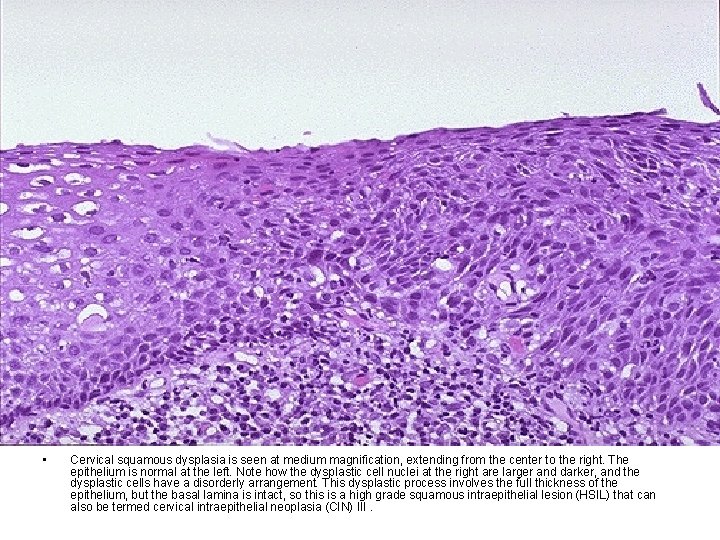 • Cervical squamous dysplasia is seen at medium magnification, extending from the center • Cervical squamous dysplasia is seen at medium magnification, extending from the center
