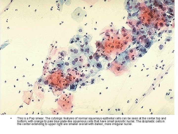 • This is a Pap smear. The cytologic features of normal squamous epithelial • This is a Pap smear. The cytologic features of normal squamous epithelial