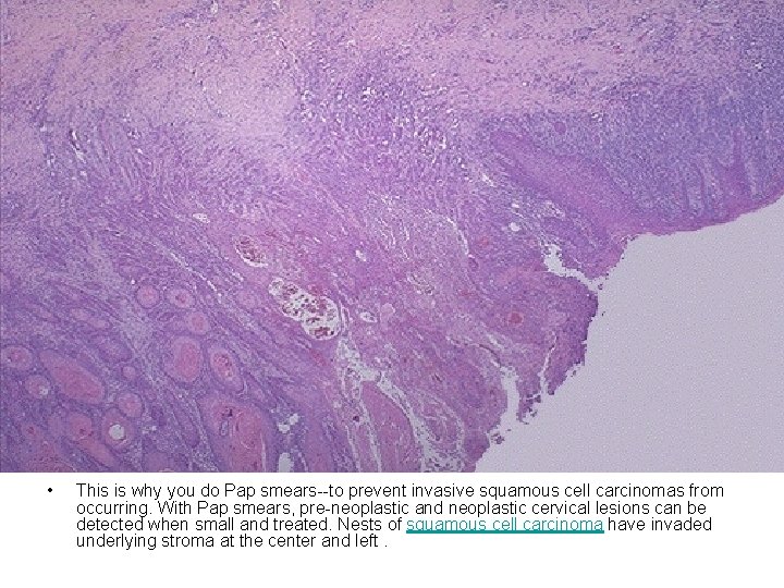  • This is why you do Pap smears--to prevent invasive squamous cell carcinomas