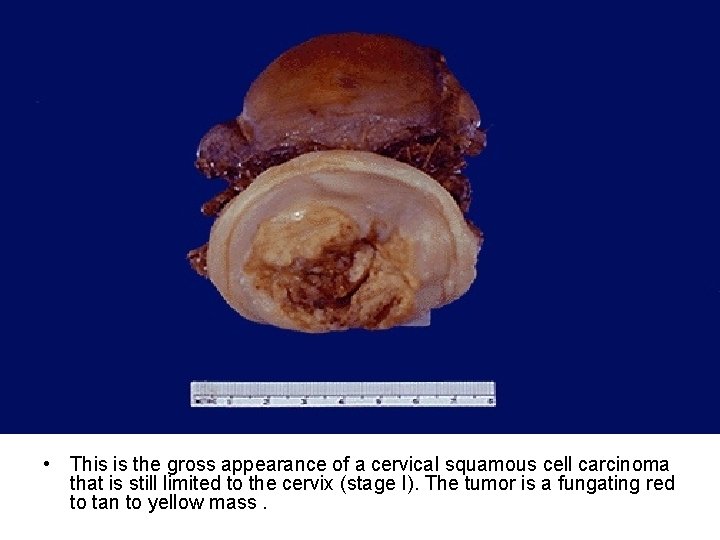  • This is the gross appearance of a cervical squamous cell carcinoma that