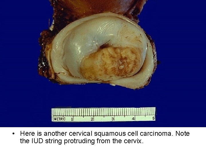  • Here is another cervical squamous cell carcinoma. Note the IUD string protruding