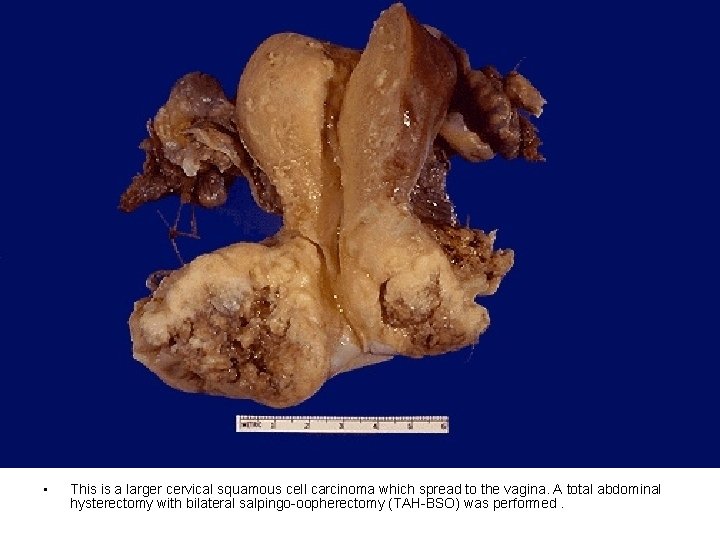  • This is a larger cervical squamous cell carcinoma which spread to the