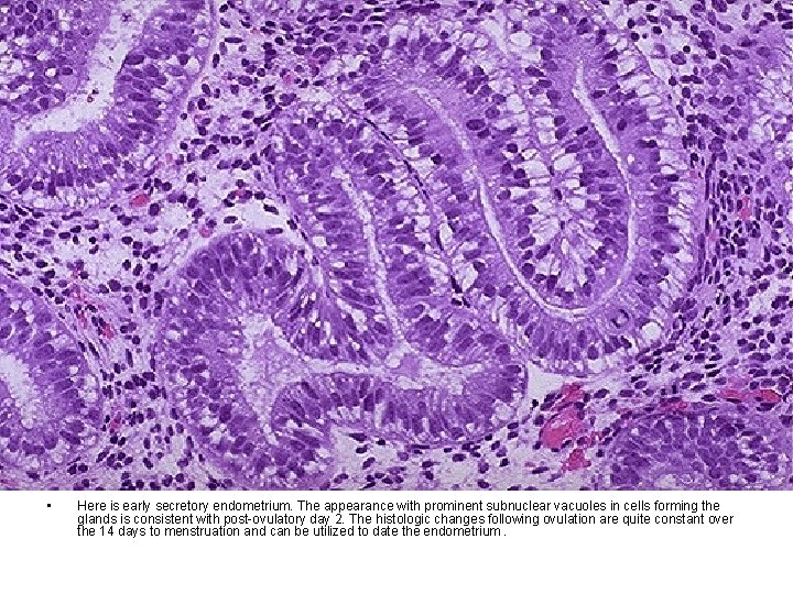  • Here is early secretory endometrium. The appearance with prominent subnuclear vacuoles in