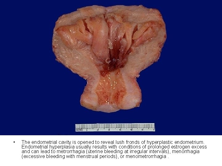 • The endometrial cavity is opened to reveal lush fronds of hyperplastic endometrium. • The endometrial cavity is opened to reveal lush fronds of hyperplastic endometrium.