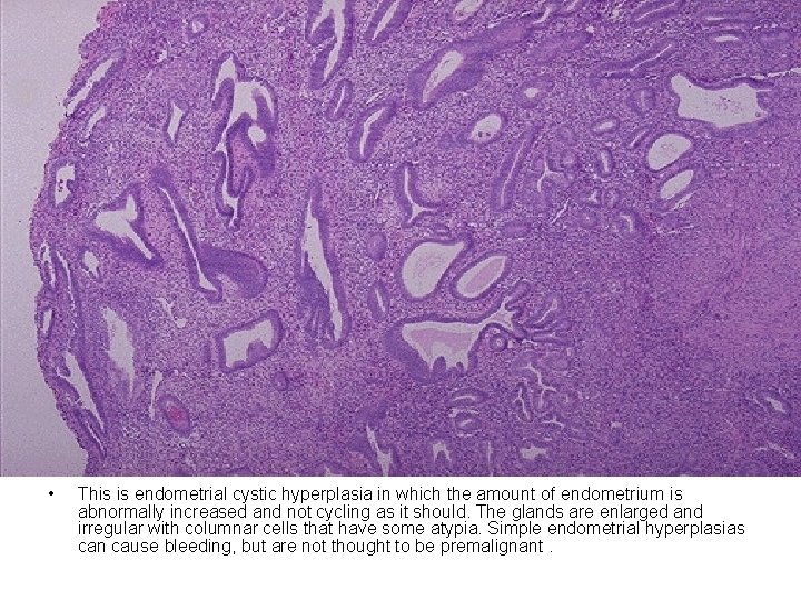  • This is endometrial cystic hyperplasia in which the amount of endometrium is