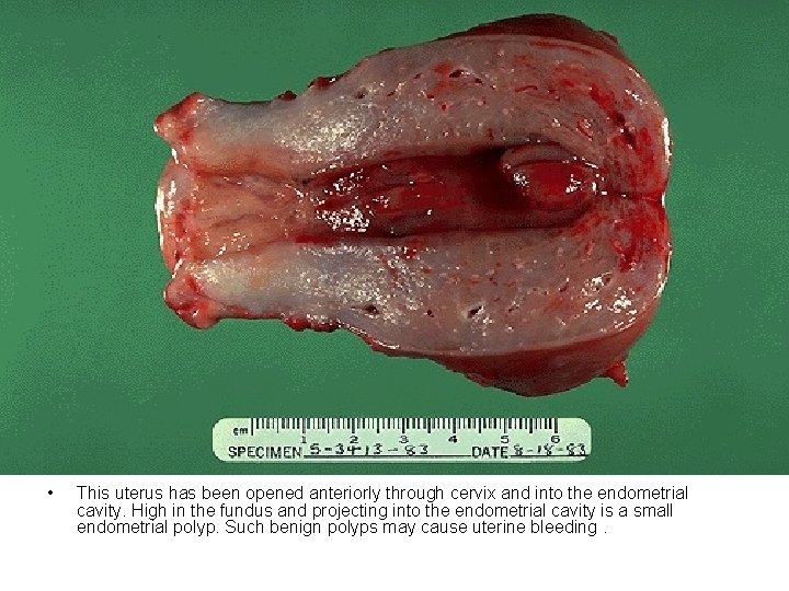 • This uterus has been opened anteriorly through cervix and into the endometrial • This uterus has been opened anteriorly through cervix and into the endometrial