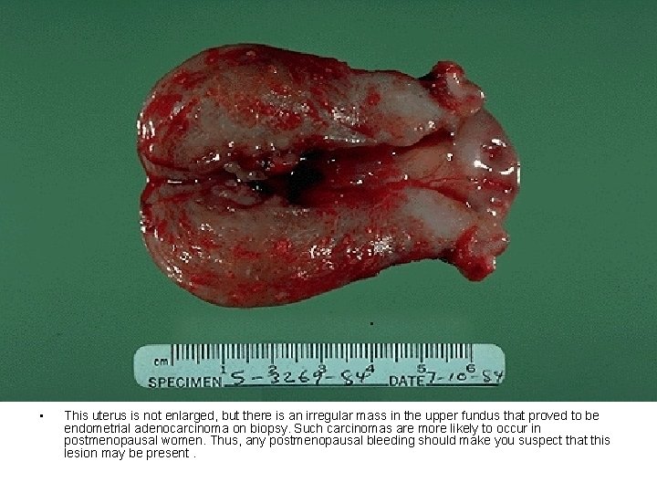  • This uterus is not enlarged, but there is an irregular mass in