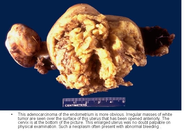 • This adenocarcinoma of the endometrium is more obvious. Irregular masses of white • This adenocarcinoma of the endometrium is more obvious. Irregular masses of white