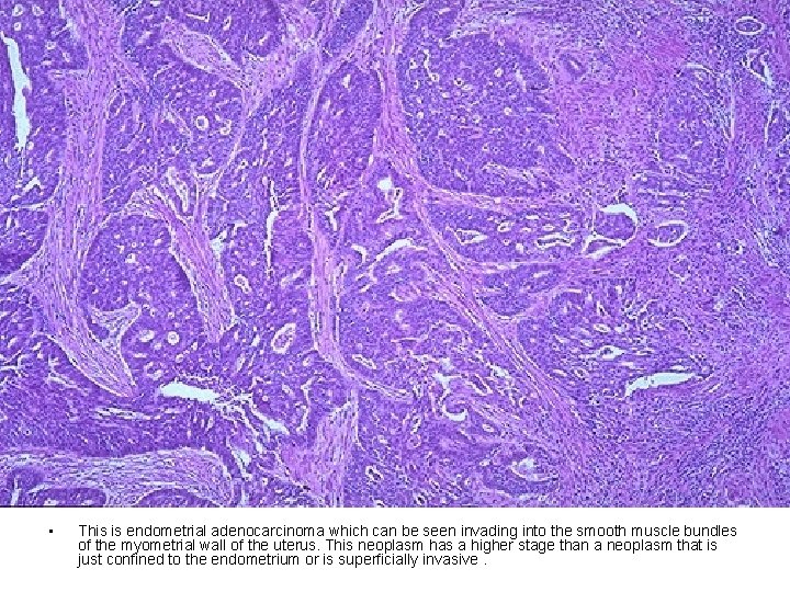 • This is endometrial adenocarcinoma which can be seen invading into the smooth • This is endometrial adenocarcinoma which can be seen invading into the smooth