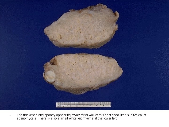  • The thickened and spongy appearing myometrial wall of this sectioned uterus is