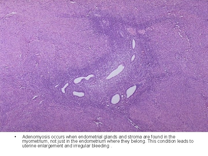  • Adenomyosis occurs when endometrial glands and stroma are found in the myometrium,