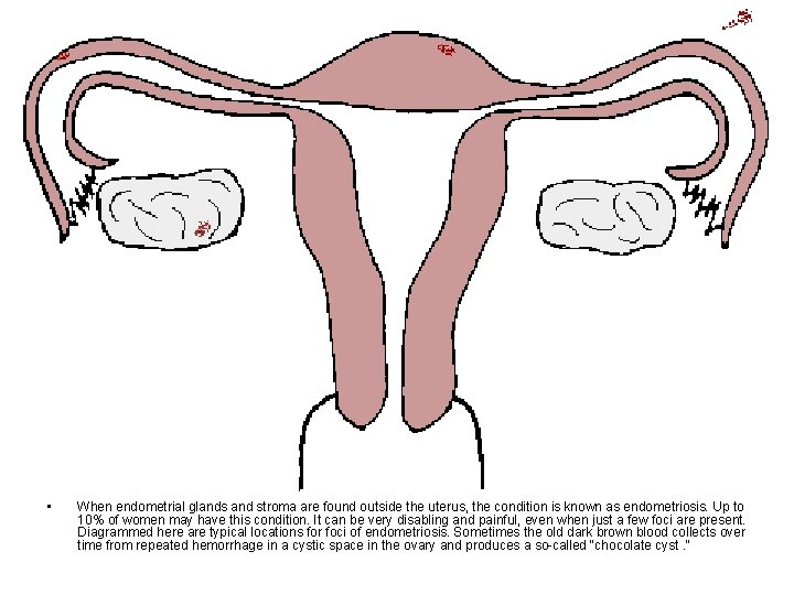 • When endometrial glands and stroma are found outside the uterus, the condition • When endometrial glands and stroma are found outside the uterus, the condition