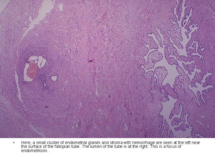  • Here, a small cluster of endometrial glands and stroma with hemorrhage are