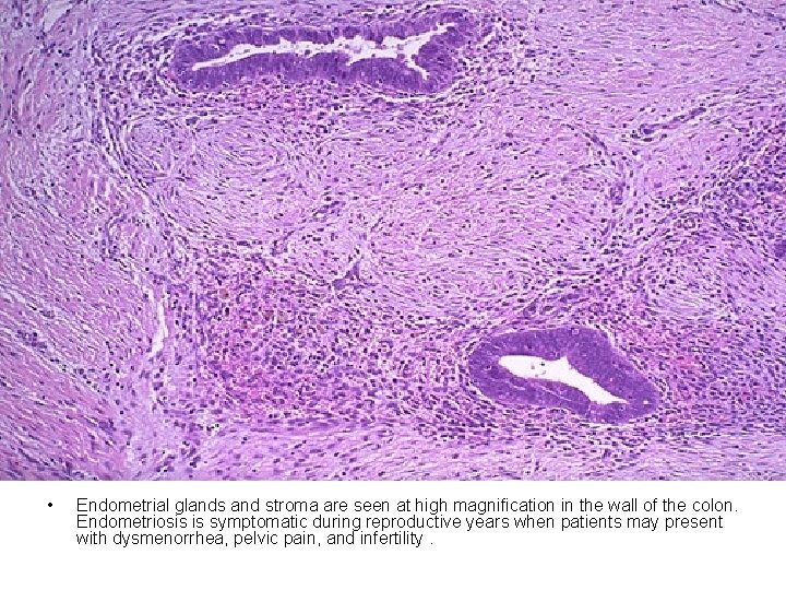  • Endometrial glands and stroma are seen at high magnification in the wall