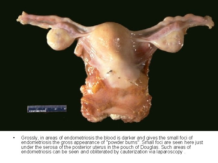  • Grossly, in areas of endometriosis the blood is darker and gives the