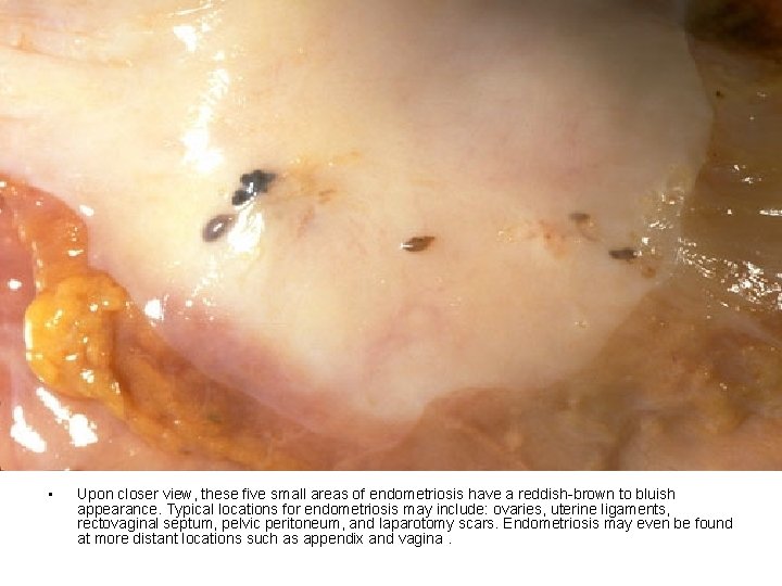 • Upon closer view, these five small areas of endometriosis have a reddish-brown • Upon closer view, these five small areas of endometriosis have a reddish-brown