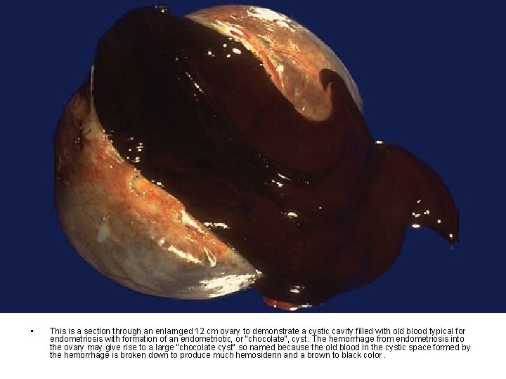  • This is a section through an enlarnged 12 cm ovary to demonstrate