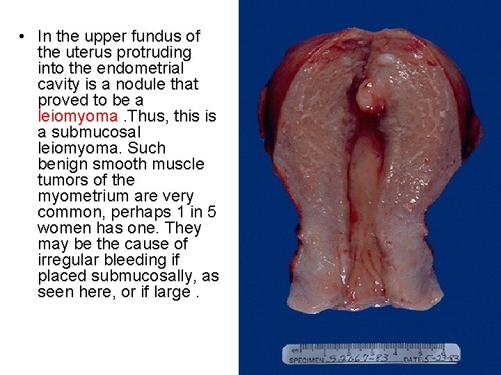 • In the upper fundus of the uterus protruding into the endometrial cavity • In the upper fundus of the uterus protruding into the endometrial cavity