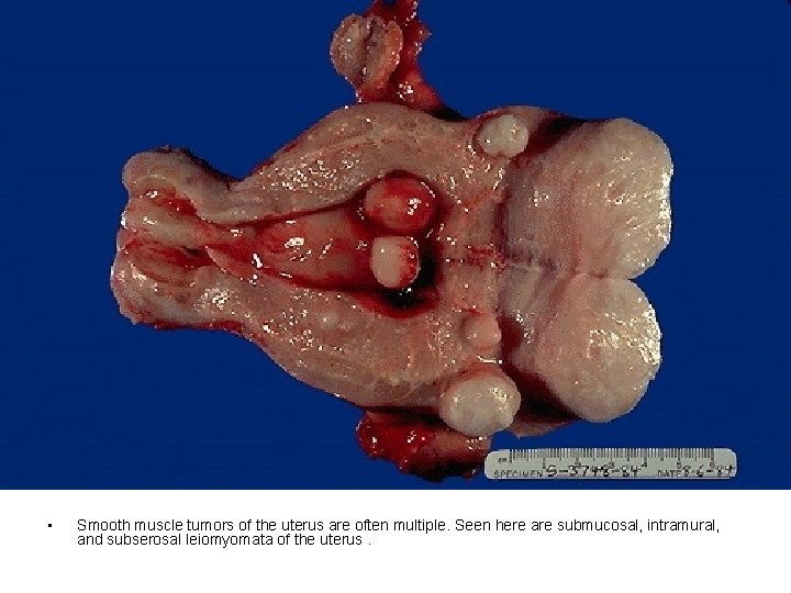 • Smooth muscle tumors of the uterus are often multiple. Seen here are • Smooth muscle tumors of the uterus are often multiple. Seen here are