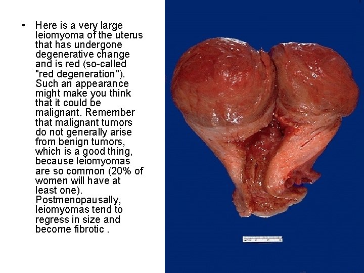  • Here is a very large leiomyoma of the uterus that has undergone