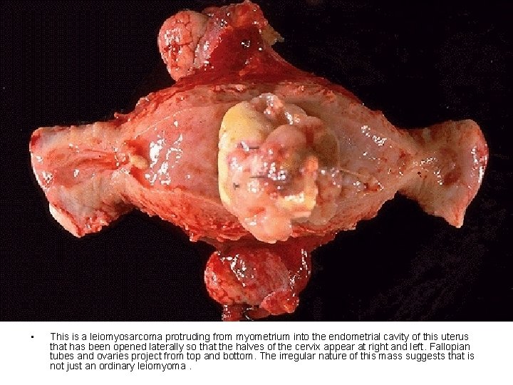 • This is a leiomyosarcoma protruding from myometrium into the endometrial cavity of • This is a leiomyosarcoma protruding from myometrium into the endometrial cavity of