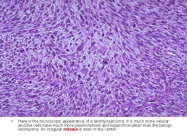  • Here is the microscopic appearance of a leiomyosarcoma. It is much more