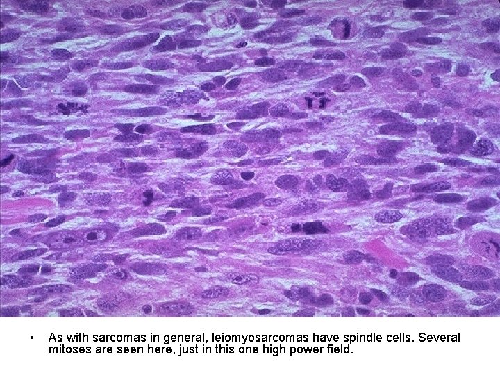 • As with sarcomas in general, leiomyosarcomas have spindle cells. Several mitoses are • As with sarcomas in general, leiomyosarcomas have spindle cells. Several mitoses are