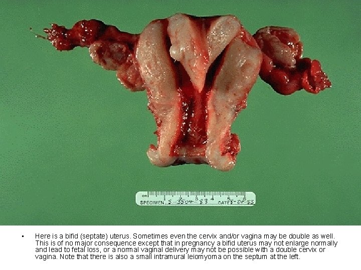  • Here is a bifid (septate) uterus. Sometimes even the cervix and/or vagina