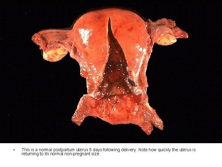  • This is a normal postpartum uterus 5 days following delivery. Note how