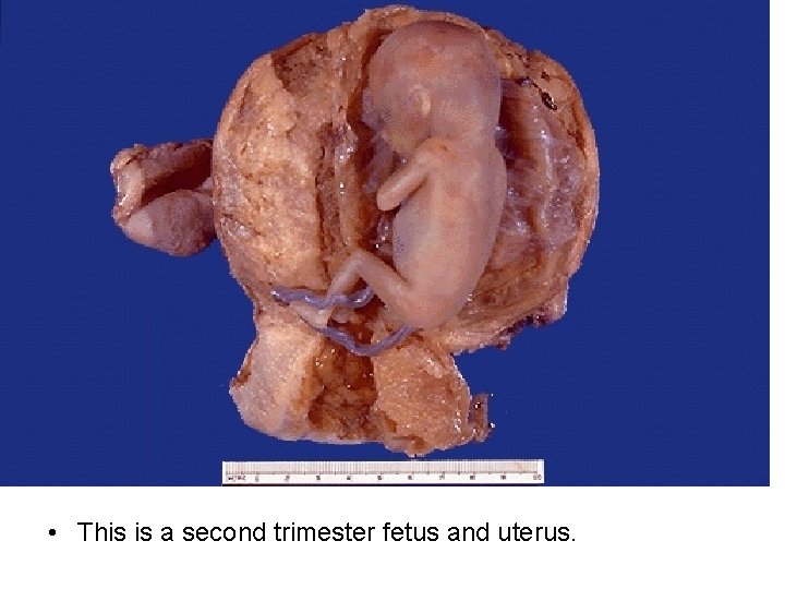  • This is a second trimester fetus and uterus. 