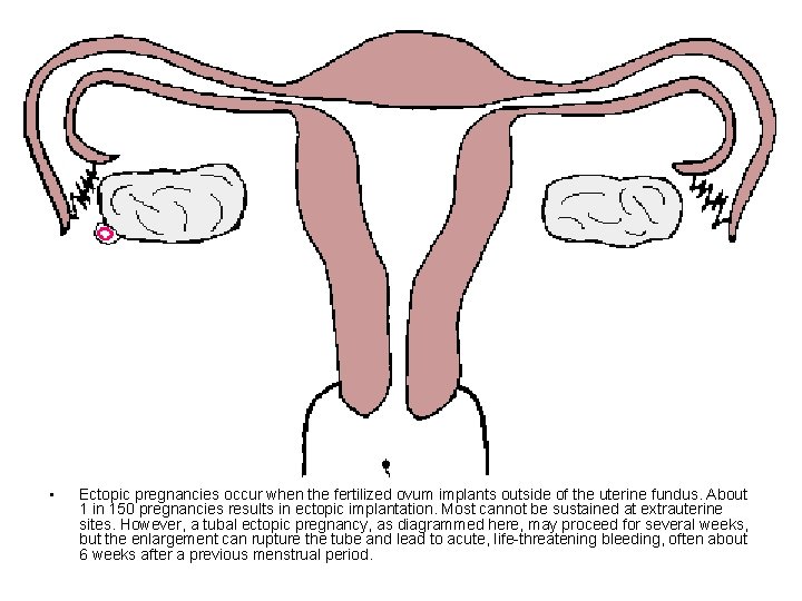  • Ectopic pregnancies occur when the fertilized ovum implants outside of the uterine