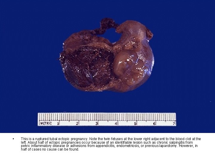 • This is a ruptured tubal ectopic pregnancy. Note the twin fetuses at • This is a ruptured tubal ectopic pregnancy. Note the twin fetuses at
