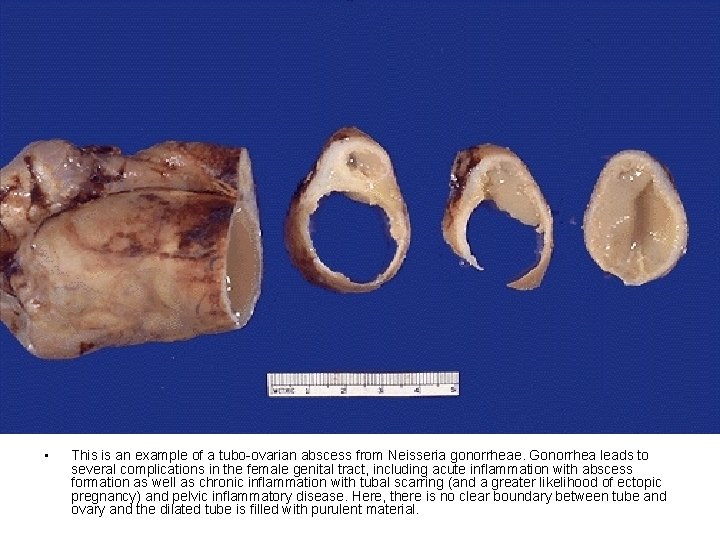  • This is an example of a tubo-ovarian abscess from Neisseria gonorrheae. Gonorrhea