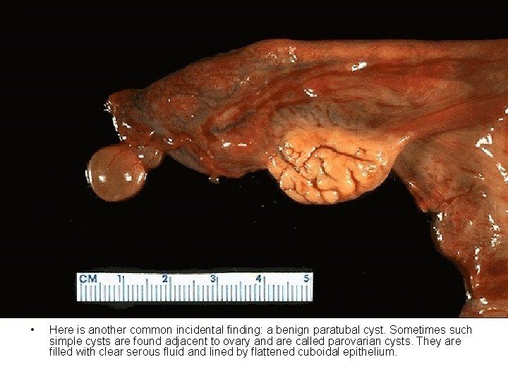  • Here is another common incidental finding: a benign paratubal cyst. Sometimes such