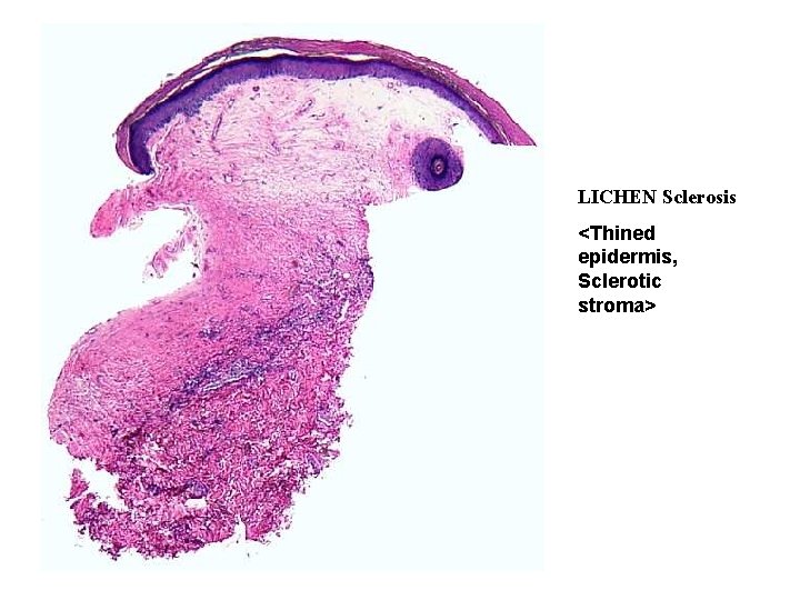 LICHEN Sclerosis <Thined epidermis, Sclerotic stroma> 