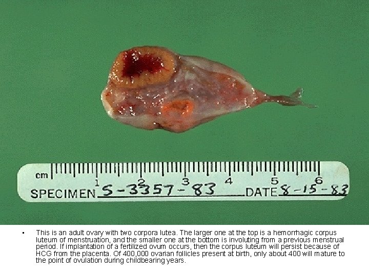  • This is an adult ovary with two corpora lutea. The larger one