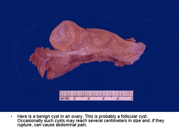  • Here is a benign cyst in an ovary. This is probably a