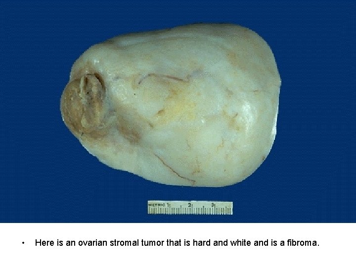 • Here is an ovarian stromal tumor that is hard and white and • Here is an ovarian stromal tumor that is hard and white and